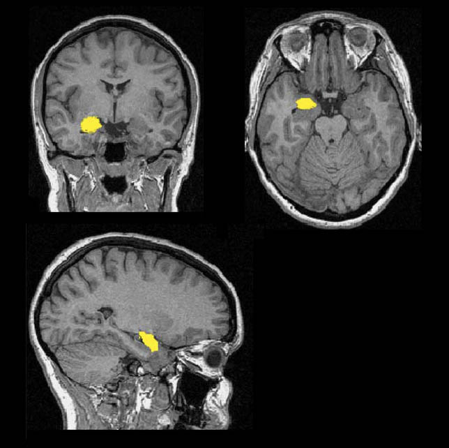   . : {Researchgate.net}(https://www.researchgate.net/figure/26654555_fig1_Fig-1-Amygdala-segmentation-Shown-are-coronal-transverse-and-sagittal-images-from-a)